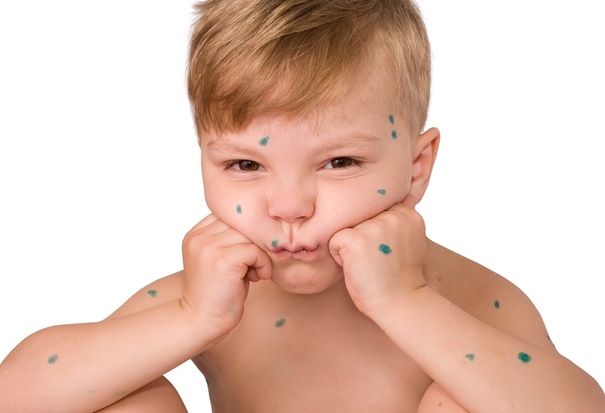 Ветряная оспа