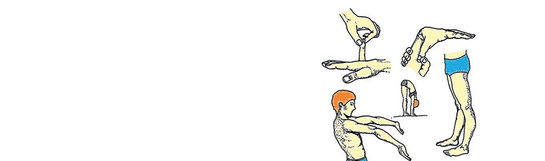 Дисплазия соединительной ткани